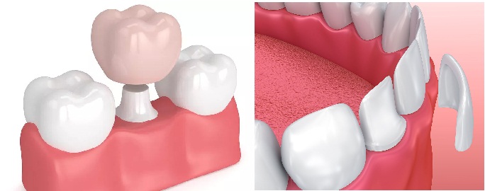 Điểm khác biệt giữa bọc răng sứ và mặt dán sứ veneer không mài răng?