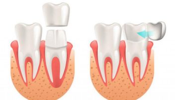 Dán sứ và bọc sứ - Phương pháp nào phù hợp dành cho bạn?
