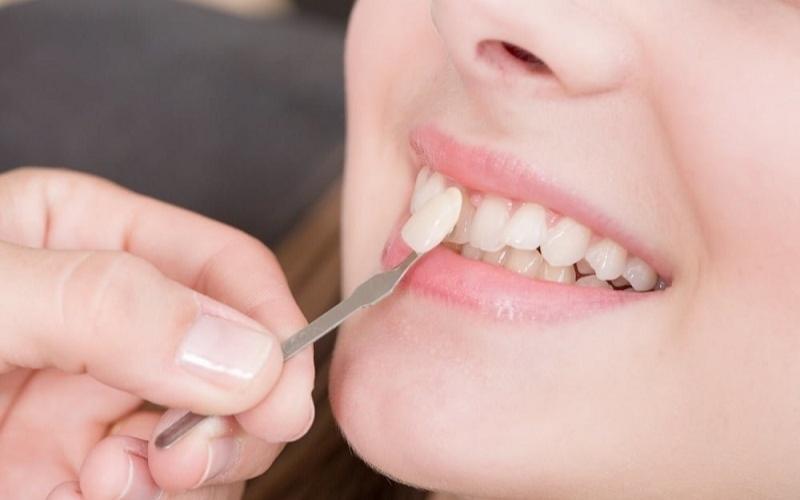Mặt dán sứ bảo tồn răng thật và ít xâm lấn
